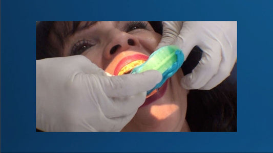 Taking the dental impression