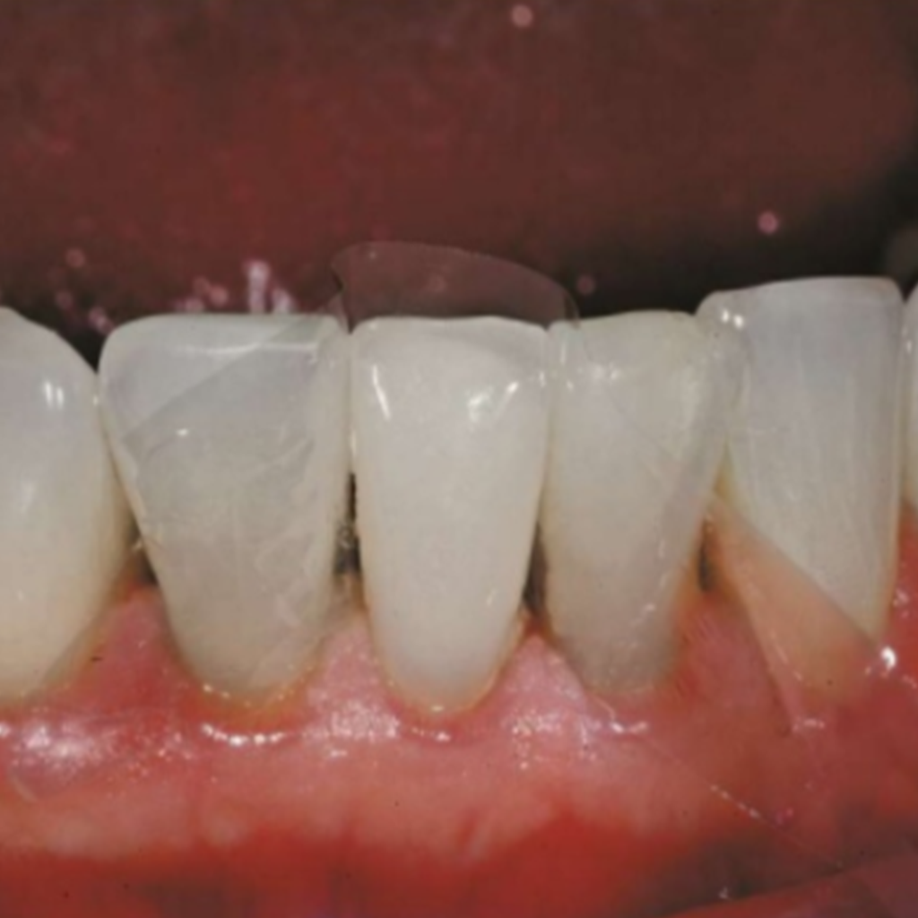 Mylar Matrix in dental application . At 9 microns thin, the material is thin enough to not leave a gap.