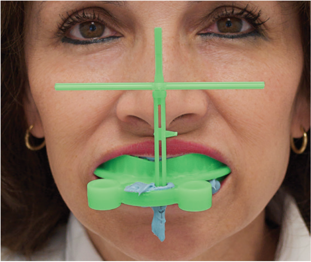 Ho Dental Harmony Dual Arch Tray in use with patient. The optional facial midline tool is in use.