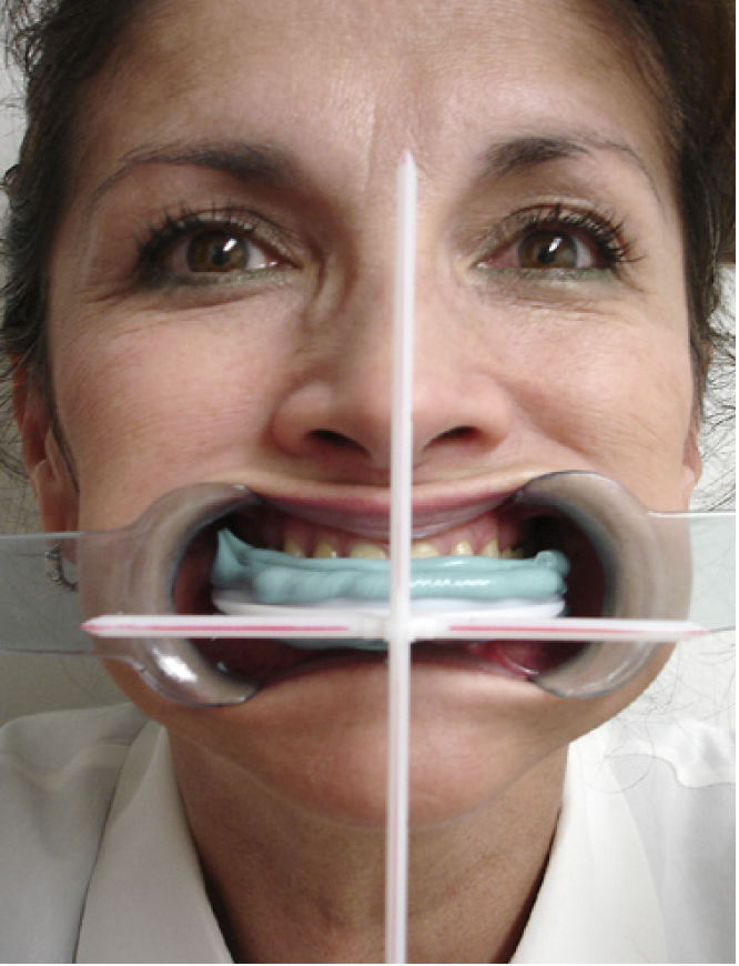 Patient with Ho Dental Facial Plane Relator in use